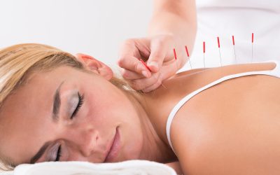 The Real Difference: Dry Needling vs. Acupuncture in Daphne, AL