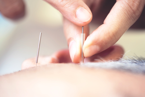 man receiving acupuncture acupuncture pensacola, acupuncture milton